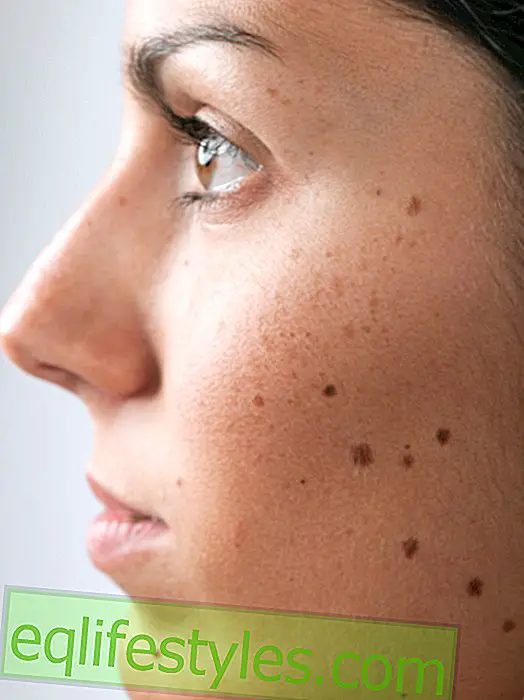 Healthy - Are liver spots actually contagious?