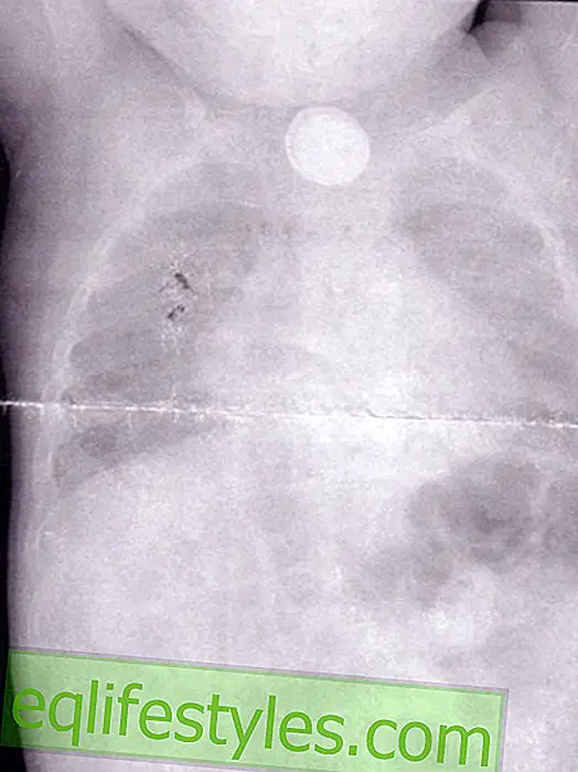 Life - Doctors found this thing in the little boy's body ... he almost died