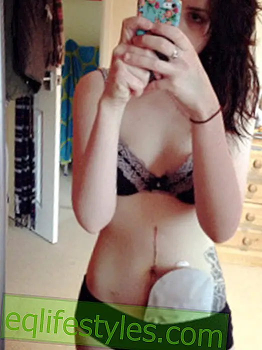 19-year-old blogs about her artificial bowel issue