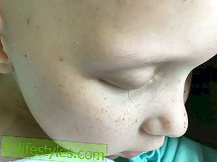 Life - Moving Story Father posts photo of the last eyelash of his cancerous daughter